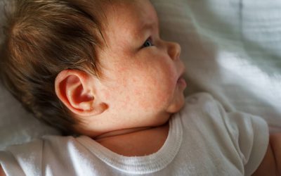 5 cosas que no sabías que irritan la piel del bebé